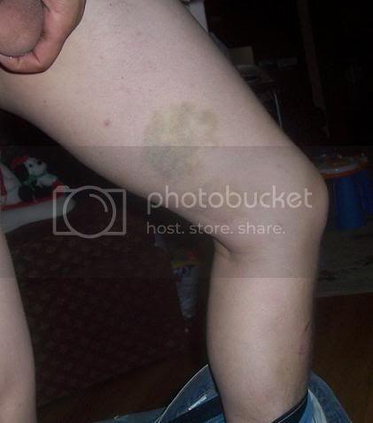 bruise2.jpg